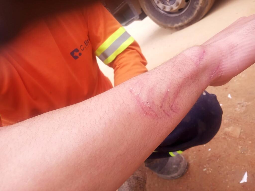 Coletor fica ferido e Prefeitura faz alerta